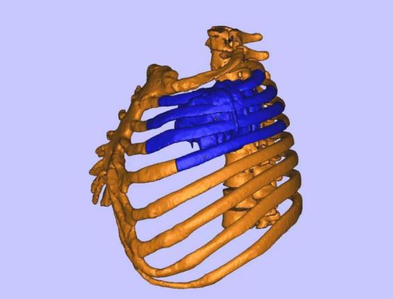 肿瘤侵袭男子胸骨3d打印助其重塑新胸廓